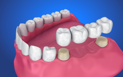 Find Out If Dental Bridges Are Right For You