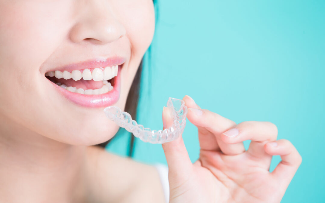 What Are The Advantages of Invisalign?