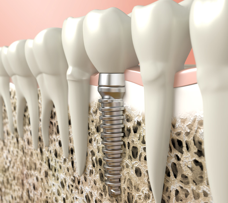 dental implants in london