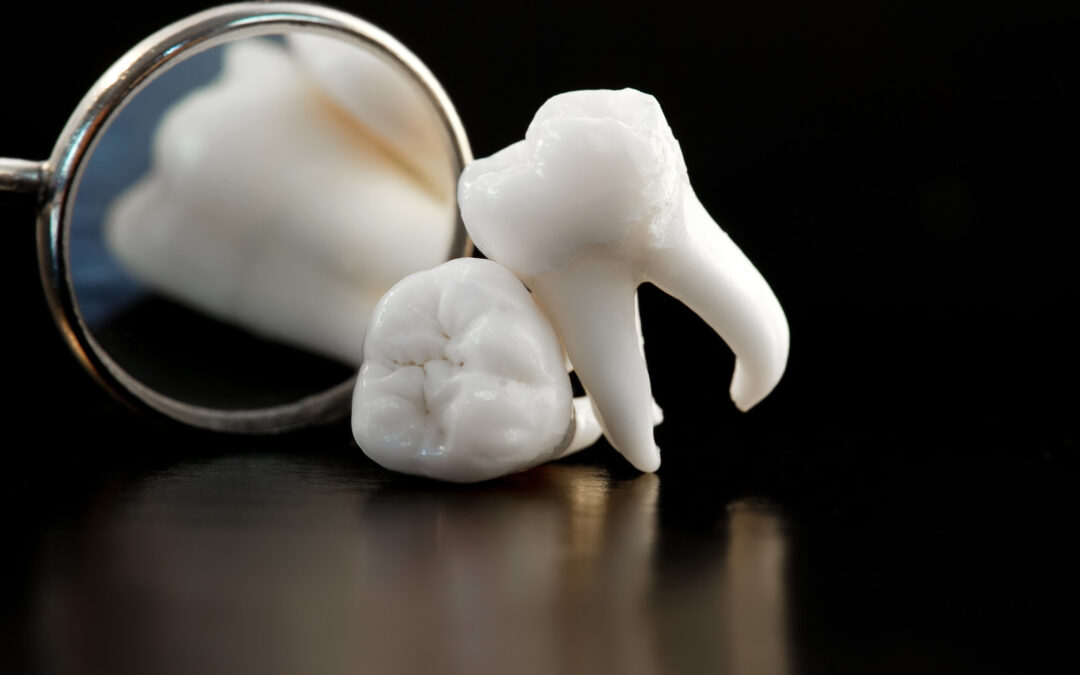 What Steps Do You Need to Take to Prepare Yourself for a Tooth Extraction?